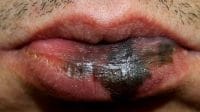 kanker-bibir Ilustrasi - Kangker bibir